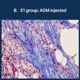 B. E1 group: ADM injected