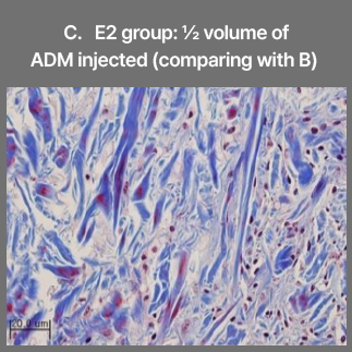 C. E2 group: ½ volume of ADM injected